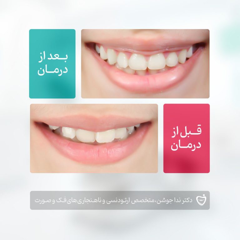 ارتودنسی دندان قبل و بعد - دکتر ندا جوشن dr neda jowshan