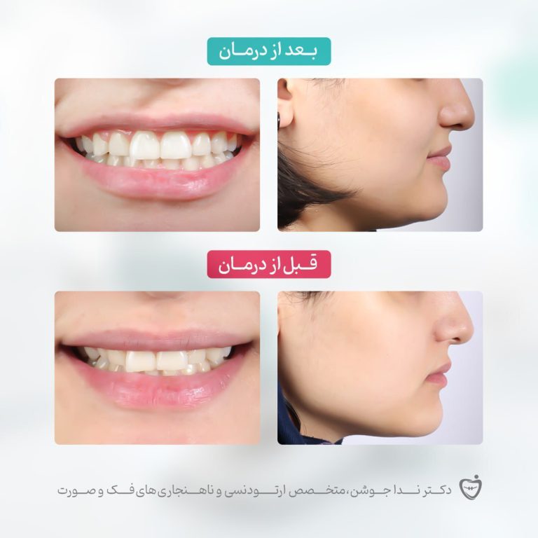 ارتودنسی دندان قبل و بعد - دکتر ندا جوشن dr neda jowshan