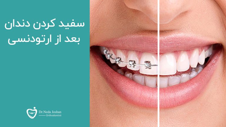 سفید کردن دندان ها بعد از ارتودنسی با 3 روش